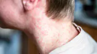 Teenager with measles rash on his face and neck