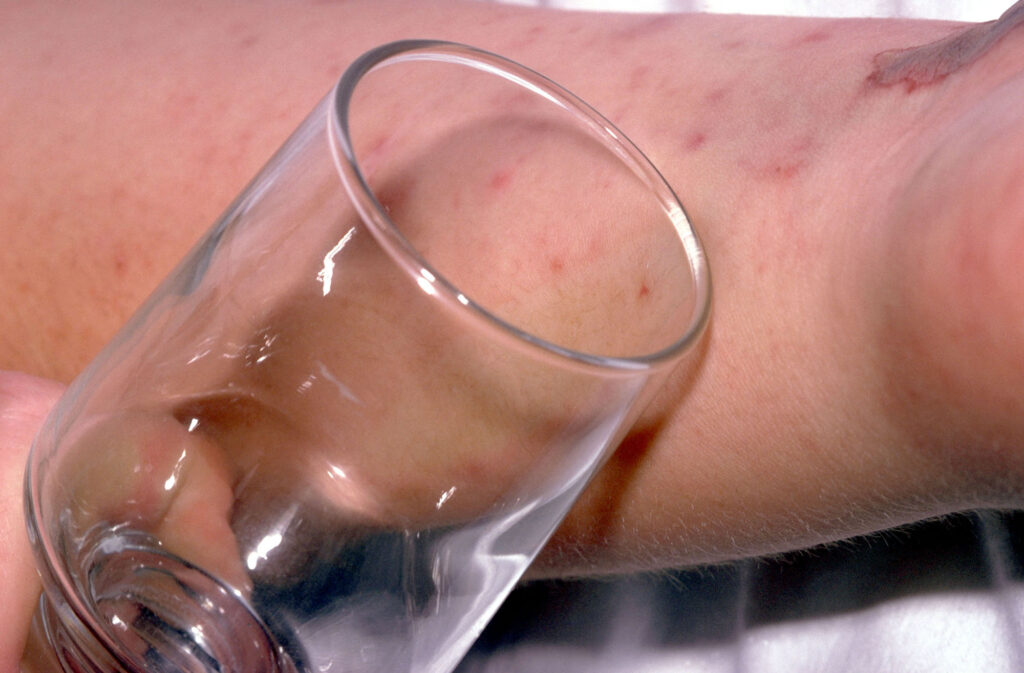 Purpuric Rash testing for Meningitis