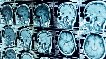A CT scan of a brain
