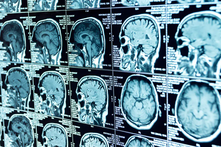 A CT scan of a brain