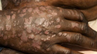 A patient with severe, extensive psoriasis all over their body.