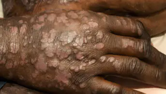 A patient with severe, extensive psoriasis all over their body.