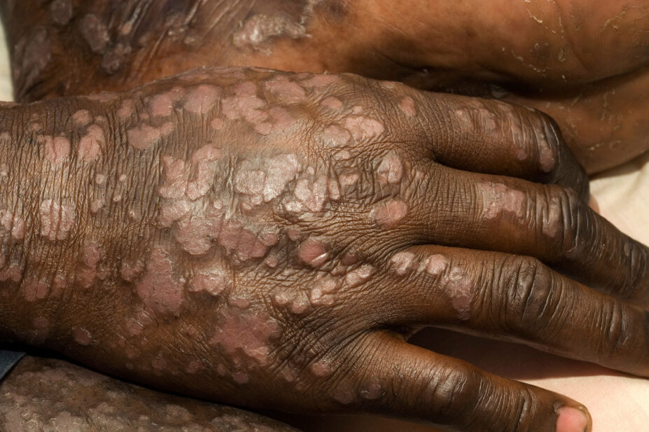 A patient with severe, extensive psoriasis all over their body.