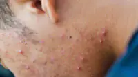 Side of mans face with acne