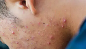 Side of mans face with acne