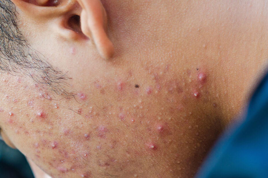 Side of mans face with acne