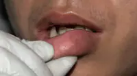 A healthcare professional examines a man with swollen lips