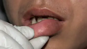 A healthcare professional examines a man with swollen lips
