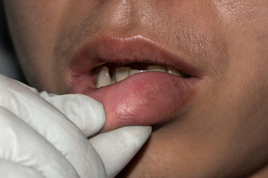A healthcare professional examines a man with swollen lips