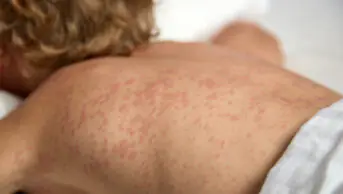 Measles rash on the back of a young boy