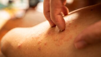 Scratching on rash on leg skin