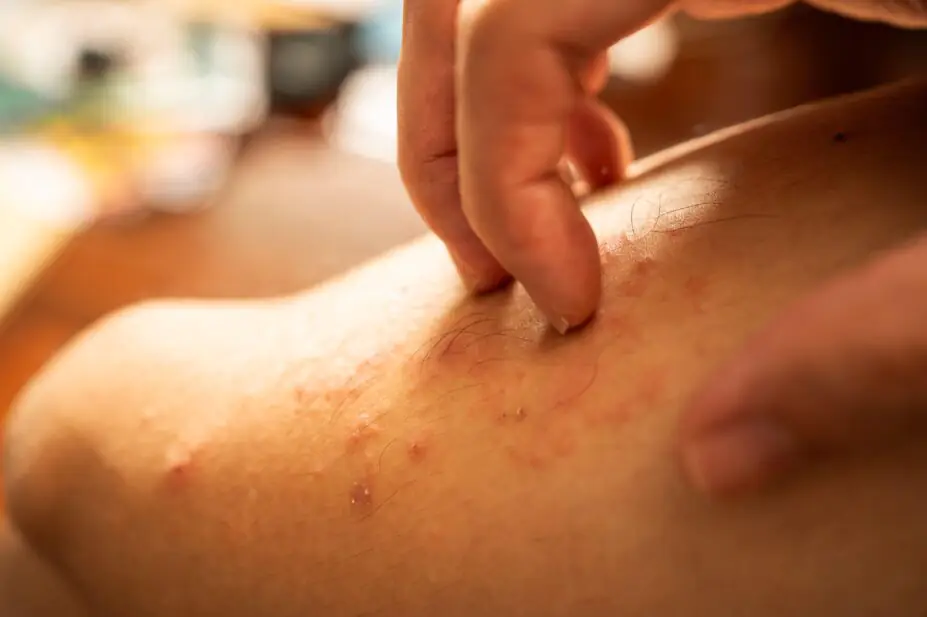 Scratching on rash on leg skin