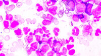 Chronic myeloproliferative neoplasm (MPNs) shown here in purple against white background. A group of blood cancers where the bone marrow produces too many blood cells.