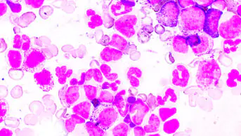 Chronic myeloproliferative neoplasm (MPNs) shown here in purple against white background. A group of blood cancers where the bone marrow produces too many blood cells.