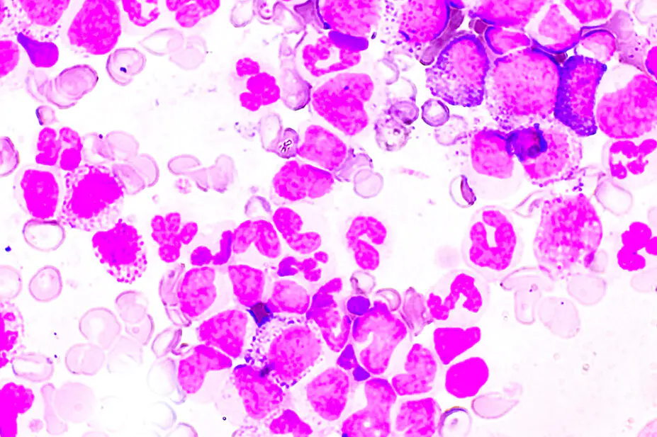 Chronic myeloproliferative neoplasm (MPNs) shown here in purple against white background. A group of blood cancers where the bone marrow produces too many blood cells.