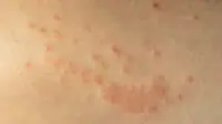 A close-up image of shingles on a person's skin