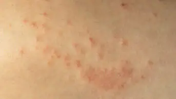 A close-up image of shingles on a person's skin