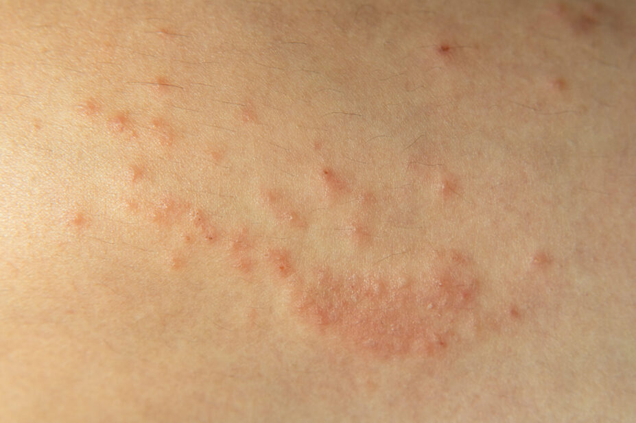 A close-up image of shingles on a person's skin