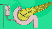 Green background with IV leading into a pancreas. Clock hands visible too
