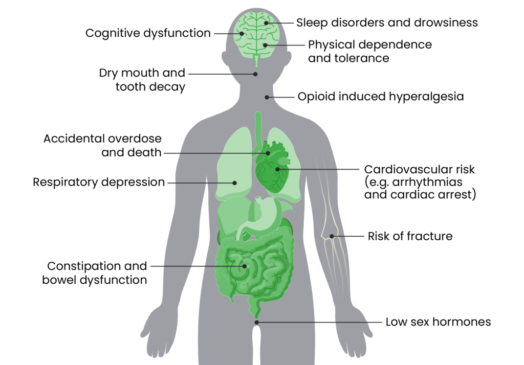 White background with body showing different side effects of opioids.