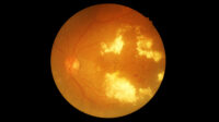 Black background with circle showing the retina photography of someone with diabetic retinopathy (cloudy yellow patches visible)