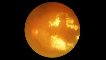 Black background with circle showing the retina photography of someone with diabetic retinopathy (cloudy yellow patches visible)