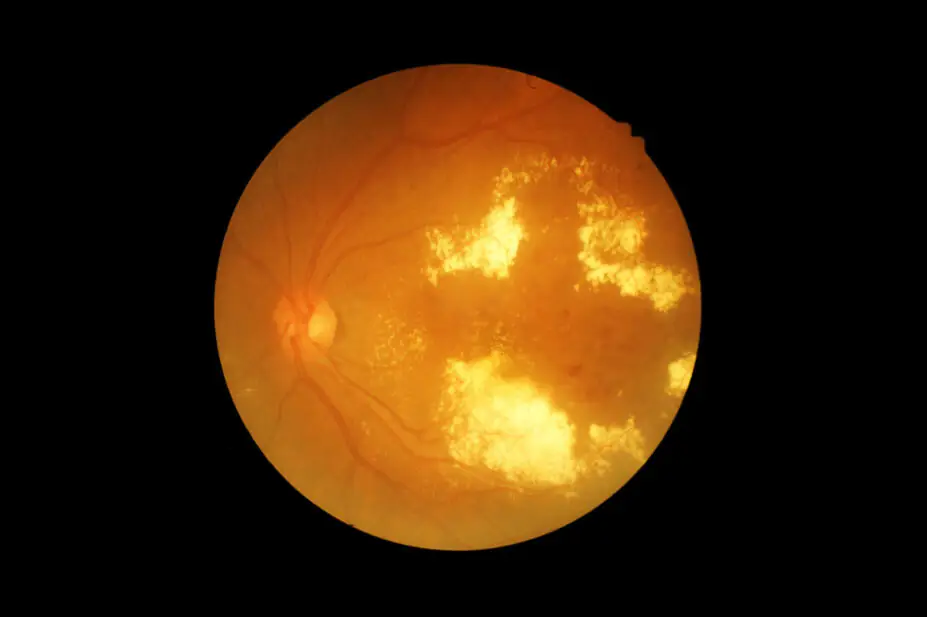 Black background with circle showing the retina photography of someone with diabetic retinopathy (cloudy yellow patches visible)